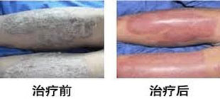 牛皮癣后期治疗图片对比