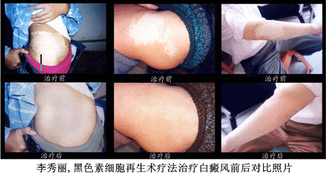 黑色素治疗白癜风成功案例