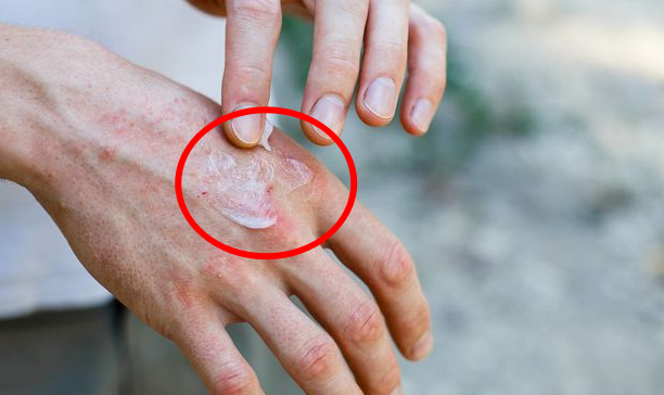 郑州治牛皮癣专科