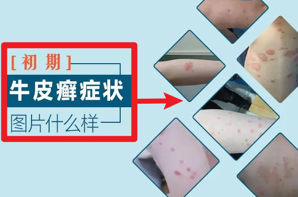 郑州治牛皮癣专科